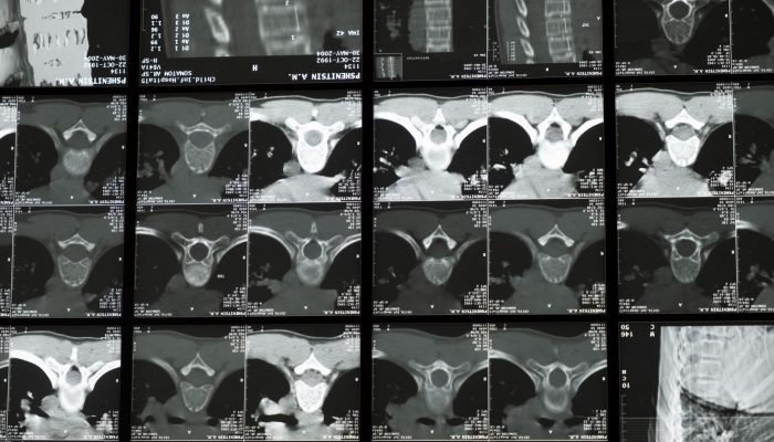neutron bone imaging
