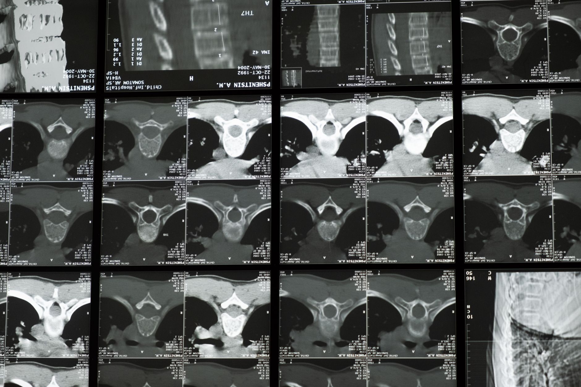 neutron bone imaging